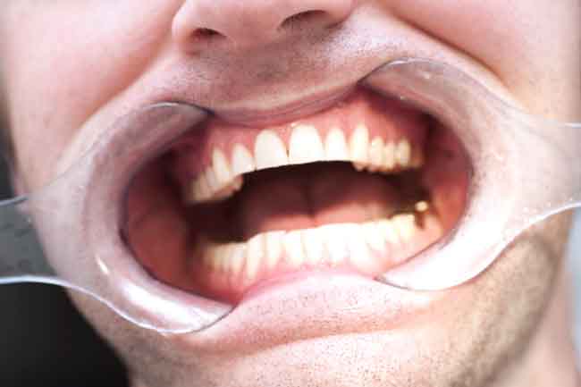 Image result for दांतों में भी भोजन 