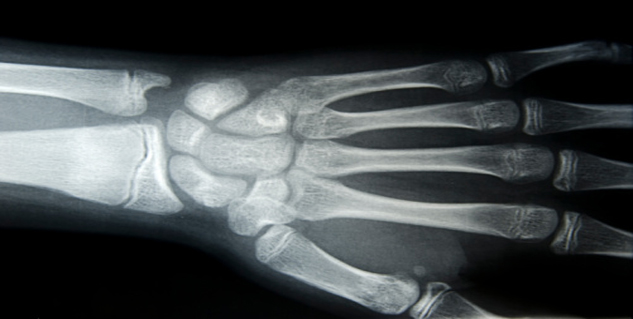 Bone Cancer in Hindi