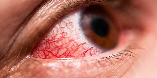 Eye flu treatment by expert