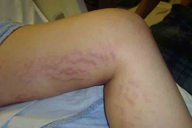 stretch marks on arms