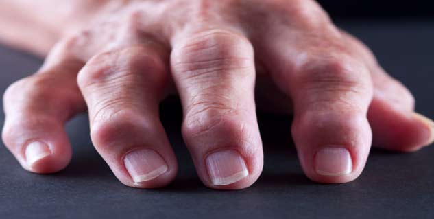 Rheumatoid in Hindi 