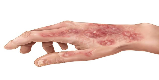 मेलानोमा Skin Cancer in Hindi