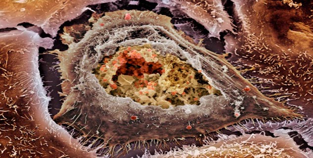 cervical Cancer in Hindi