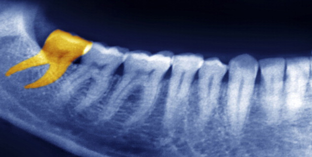 Wisdom tooth in Hindi