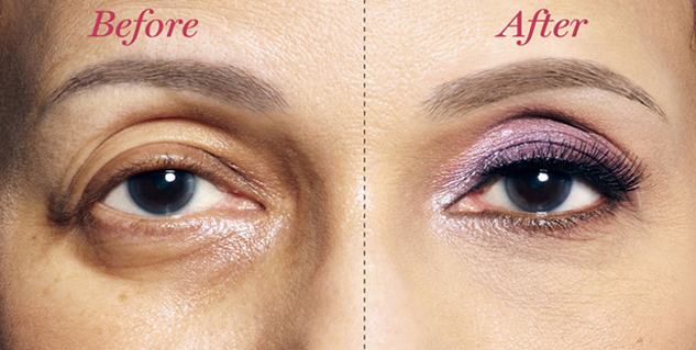 Droopy Eyes in Hindi