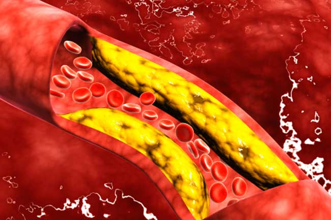 clean arteries naturally