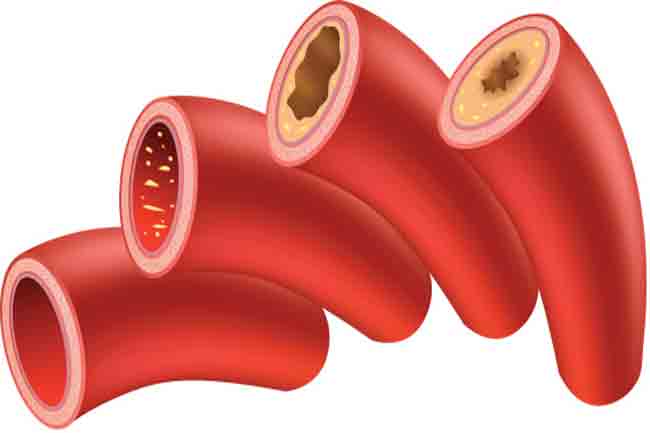 home-remedies-to-clean-clogged-arteries-and-blood-vessels-in-hindi