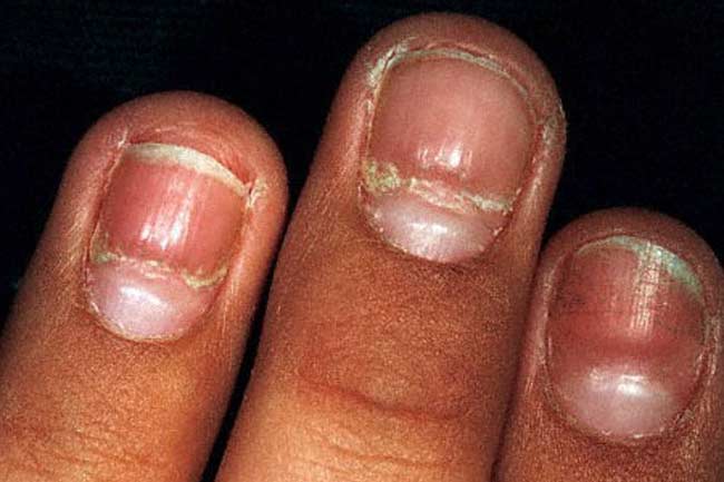 7-nail-problems-you-should-look-out-for