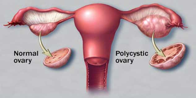 polycystic ovary syndrome in hindi 
