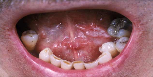 oral cancer in hindi 