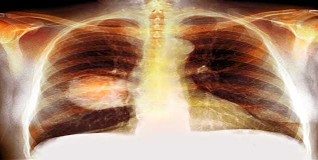 small cell lung cancer in hindi 