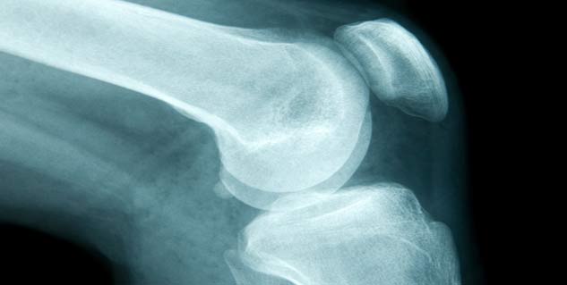 बोन कैंसर bone cancer in hindi