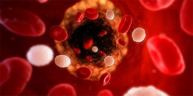 Atherosclerosis: When should one seek medical advice