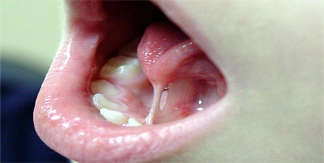 tongue tie in hindi 