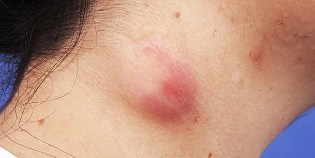 सिबेसियम सिस्ट sebaceous cysts in hindi