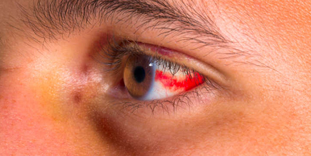 subconjunctival hemorrhages in hindi 