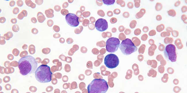 Patients with type II diabetes are prone to develop cancer