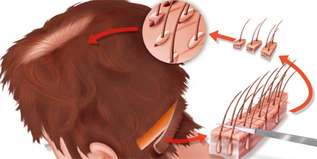 Hair transplant