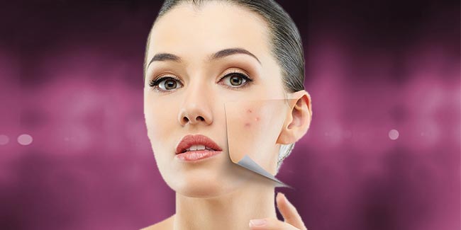 tips-to-get-rid-of-pimples-overnight