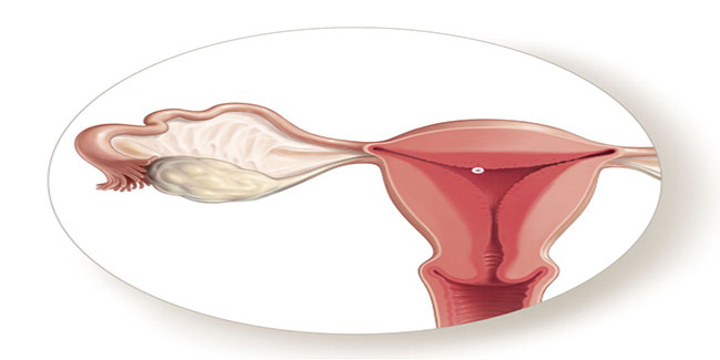 Successful womb implant raises hope for infertile women