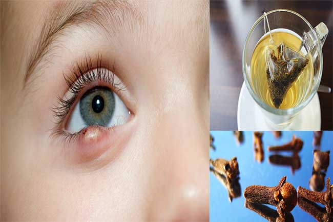 home-remedies-to-cure-anjanhari-guheri-eye-sty-in-hindi