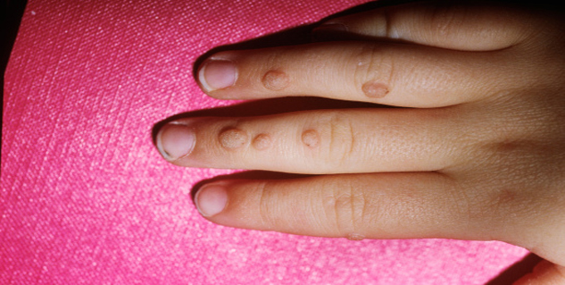 warts