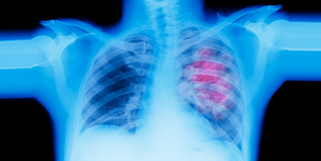 लंग कैंसर 