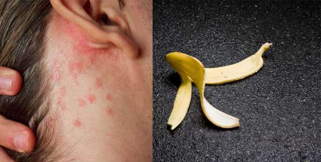 psoriasis  in hindi 