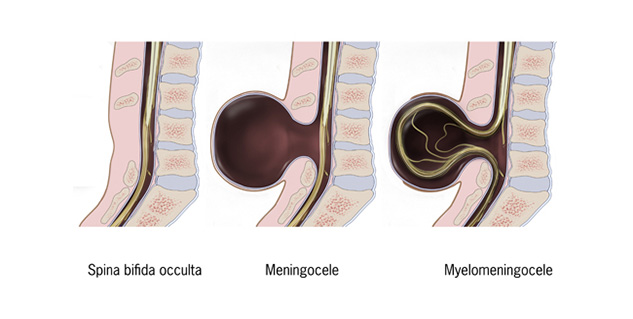 types of spina bifida