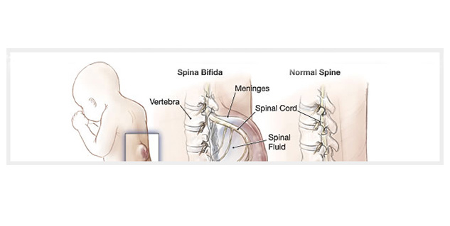 spina bifida