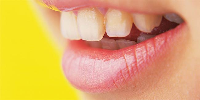 yellow around teeth calculus