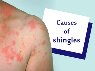 Ayurvedic Treatment of Shingles | Alternative Therapies