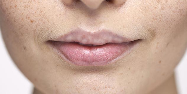 white-spots-above-on-lip