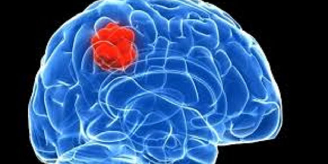 symptoms-of-brain-tumour-in-hindi