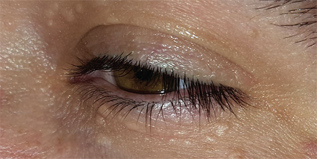 get-rid-of-those-ugly-bumps-around-your-eyes-with-these-natural-remedies