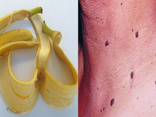 त्‍वचा के मस्सों छुटकारा दिलाते हैं ये 3 आसान उपाय, दाग-धब्‍बे से भी मिलेगी निजात 