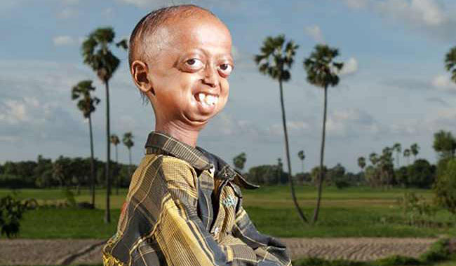 बच्‍चों को बूढ़ा बनाने वाले इस रोग का वैज्ञानिकों ने ढूंढा इलाज! 