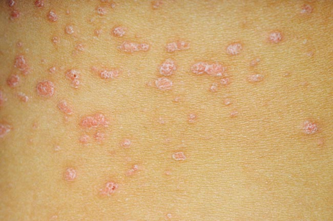 these-4-reasons-to-psoriasis-in-hindi