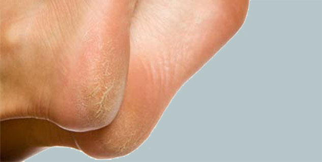 cracked heel in hindi 