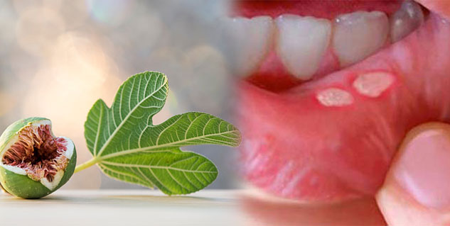 mouth ulcer in hindi 