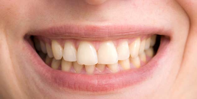yellowness of your teeth