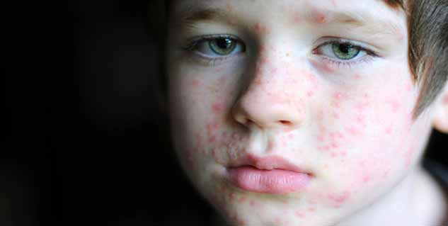 allergy and itching