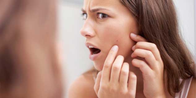acne in hindi 
