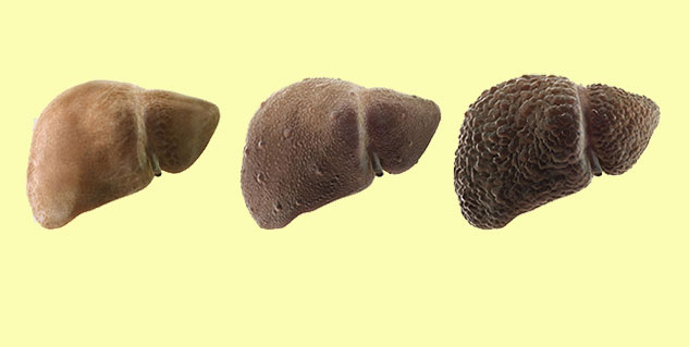 liver cancer