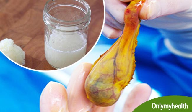गॉल ब्लैडर की पथरी को कुछ ही दिनों में काटता है प्याज का रस, जानें कैसे?
