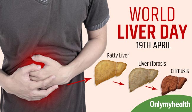 World Liver Day: Know the Progression of Liver Disease