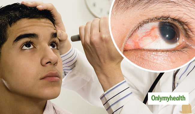 खतरनाक हो सकती है आंखों के पर्दे की सूजन, जानें क्या हैं लक्षण और उपचार