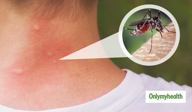 dengue mosquito bite