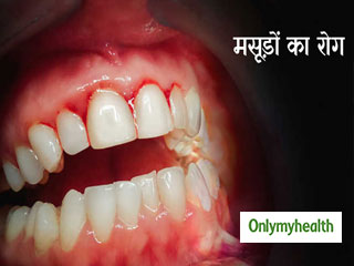 मसूड़ों का खतरनाक रोग है पेरिओडॉन्टाइटिस, कई अन्य बीमारियों के देता है जन्म