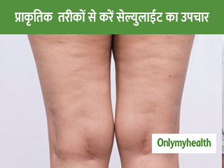 सेल्युलाईट रोग बिगाड़ देता है महिलाओं की खूबसू‍रती, जानें कारण और प्राकृतिक उपचार